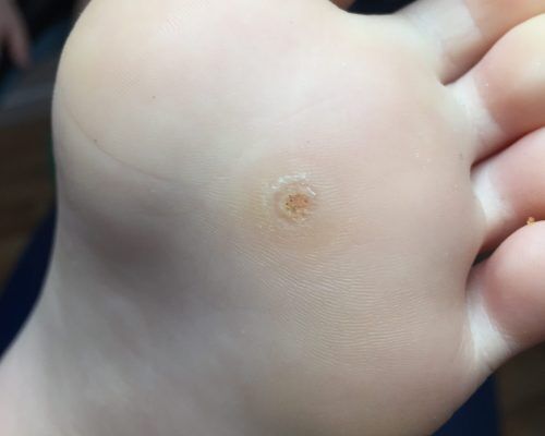 Wart Treatment in Perth | Plantar Wart Removal
